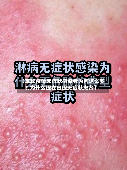 【本轮疫情无症状感染者为何这么多?,为什么现在出现无症状患者】-第1张图片